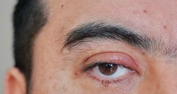 Was ist Blepharitis (Augenlidentzündung)? Wie besteht man?