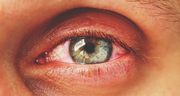 Was ist Pink Eye? Was sind die Symptome?