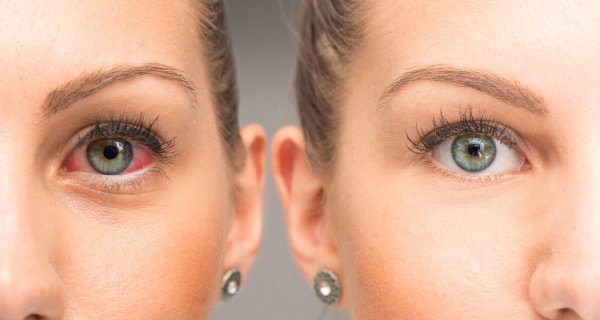 Was ist trockenes Auge? Wie wird trockenes Auge behandelt?