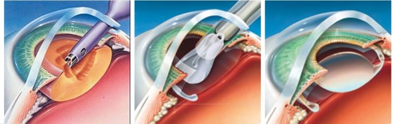 multifocal