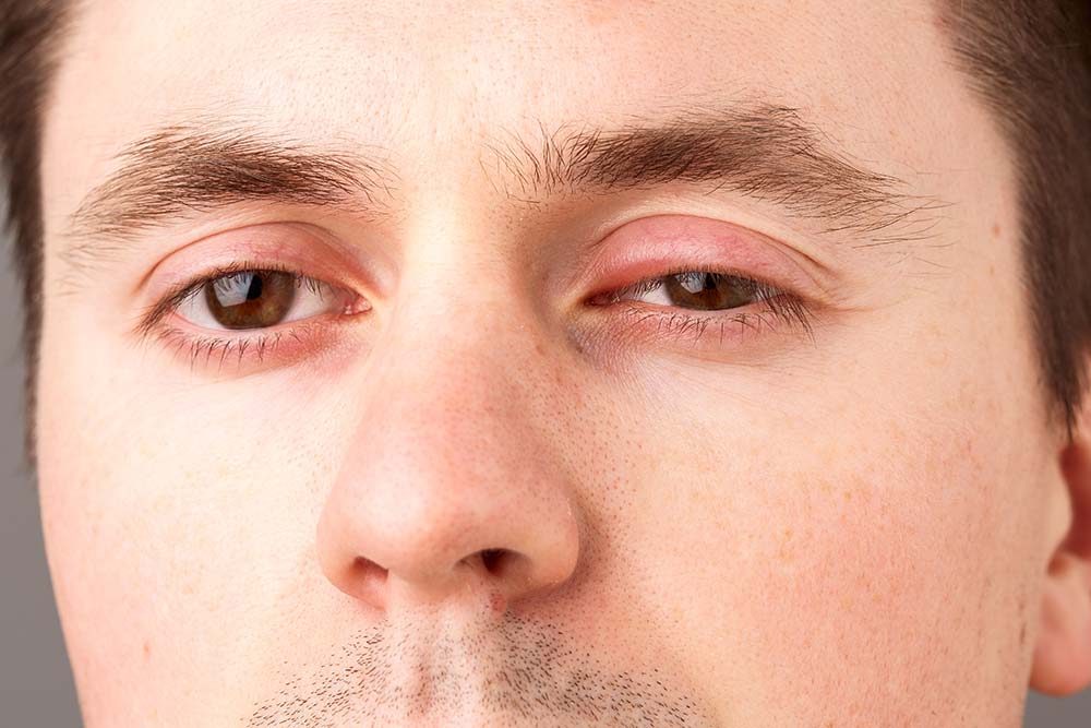 Schwellung des Augenlids