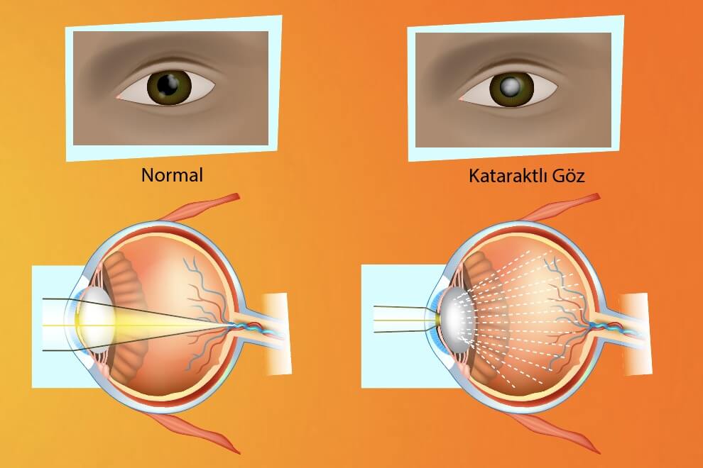 katarakt-nedir -symptoms-nedir 