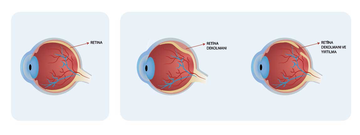 retina-dekolmani